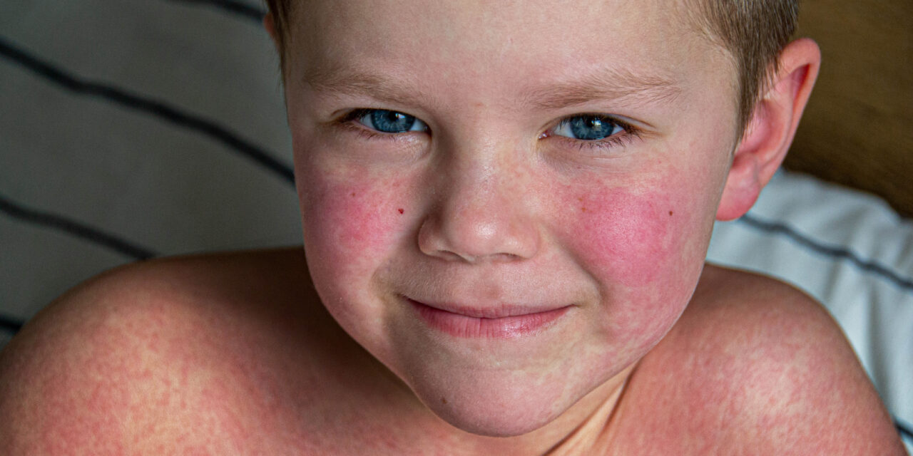 Common Summer Rashes in Children: Symptoms, Causes, and Prevention