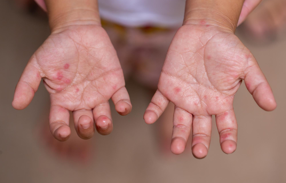 Hand, Foot & Mouth Disease in Children: Symptoms, Causes, Diagnosis, Treatment, and Prevention