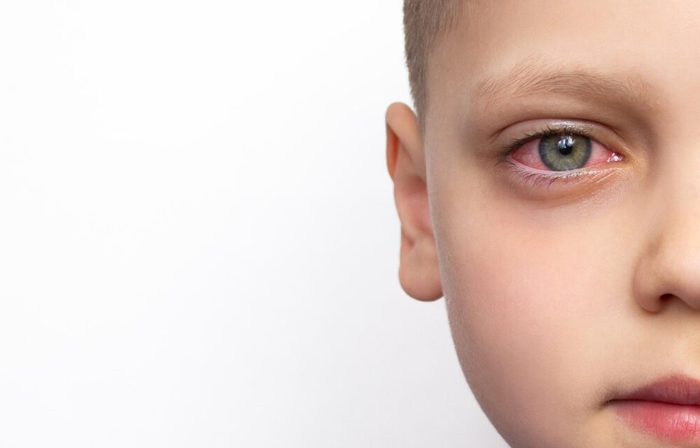 Conjunctivitis (Eye Flu) in Kids: Managing the Monsoon Outbreak